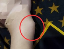 Diduga Ada Kelalaian Prosedur Imunisasi, Kasus Pembengkakan Balita di Puskesmas Cicalengka Disorot